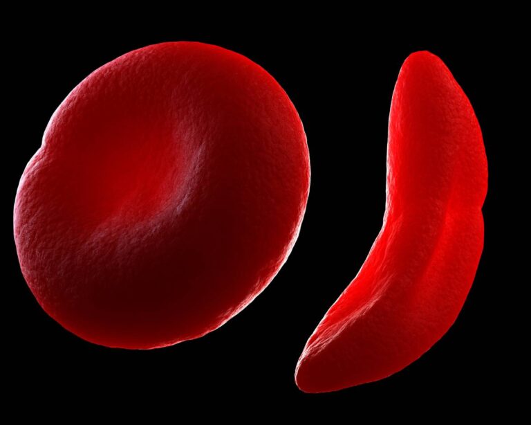 Tudo o que você precisa saber sobre a anemia falciforme