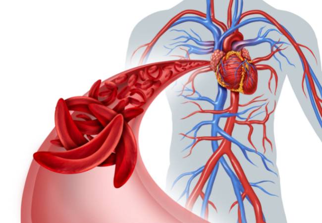 Entenda melhor a anemia falciforme