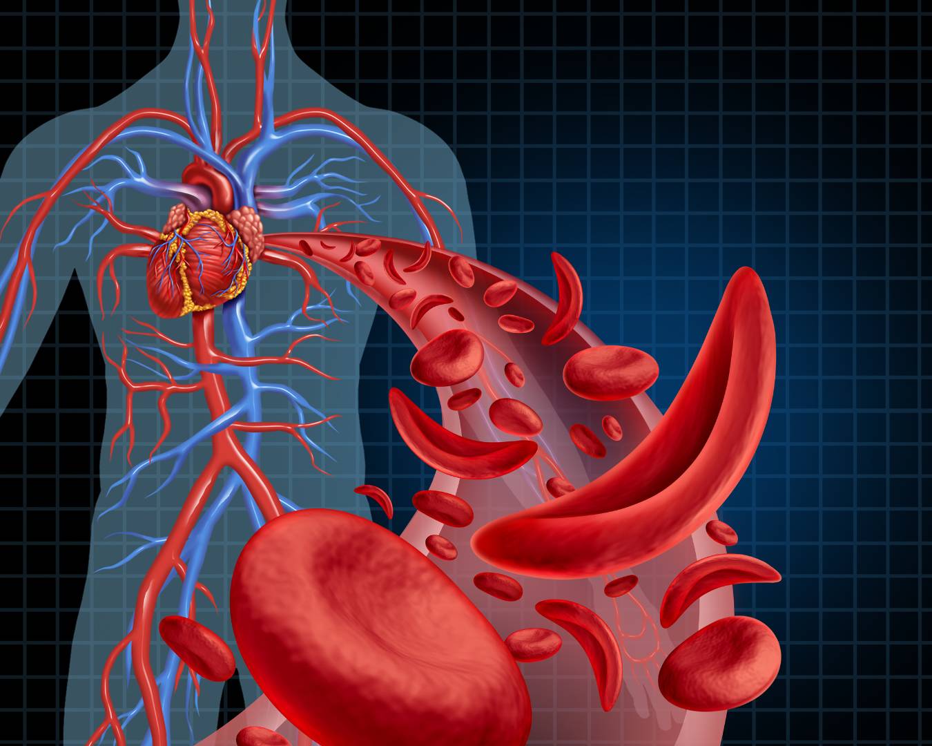 Veja as principais causas de anemia falciforme