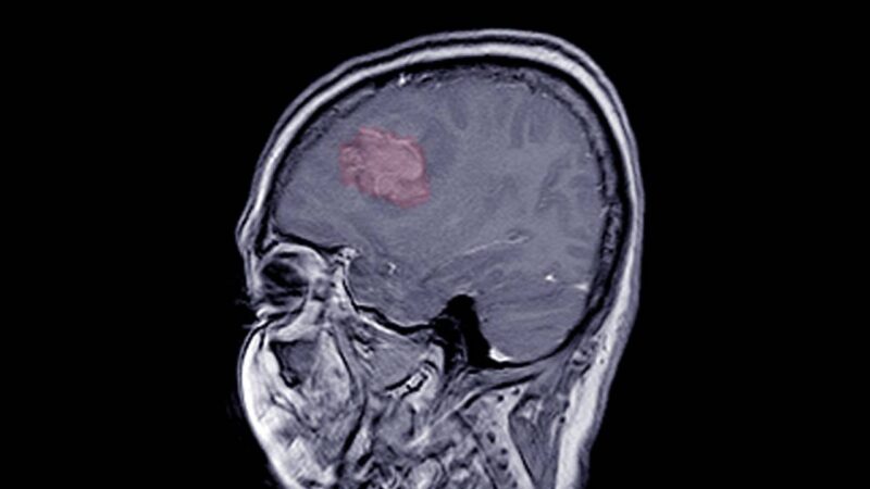 Imagem de Meningioma - Canva.