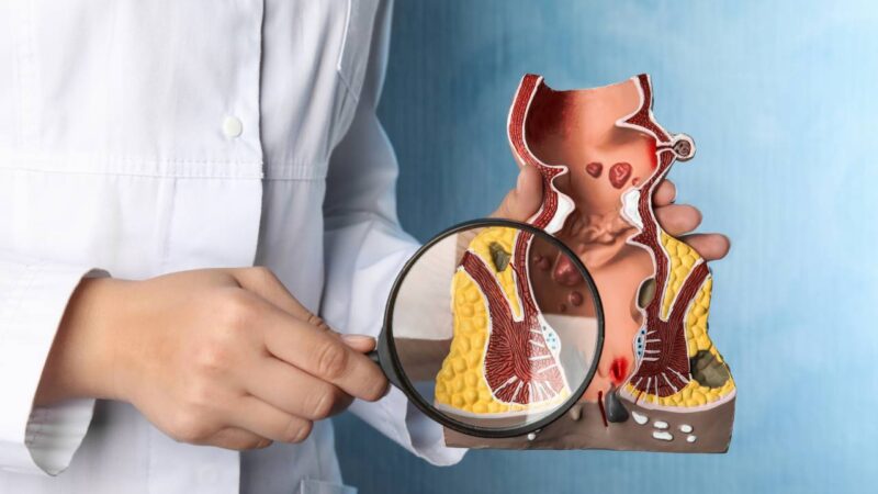 Médico demonstrando anatomia da Hemorroida.