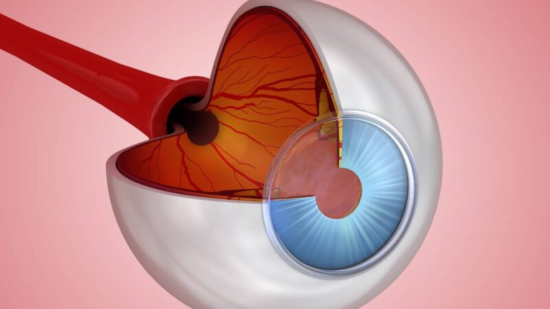Olho com glaucoma.