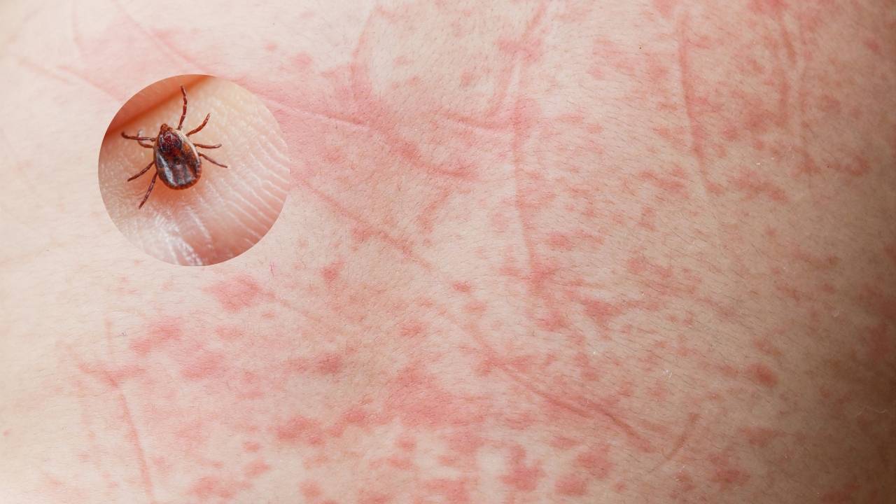 Febre Maculosa: O que é, Sintomas, Causas, Tratamento e Prevenção!