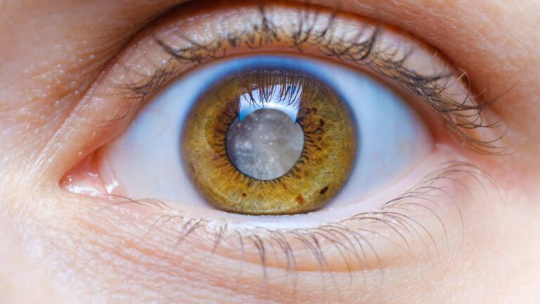 Glaucoma: O que é, Sintomas, Causas, Diagnóstico e Tratamentos.