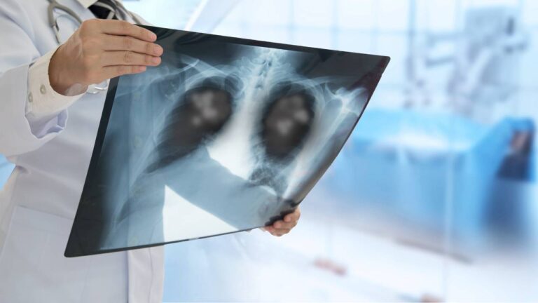 Pneumonia Bilateral: O que é, Sintomas, Causas e Tratamento