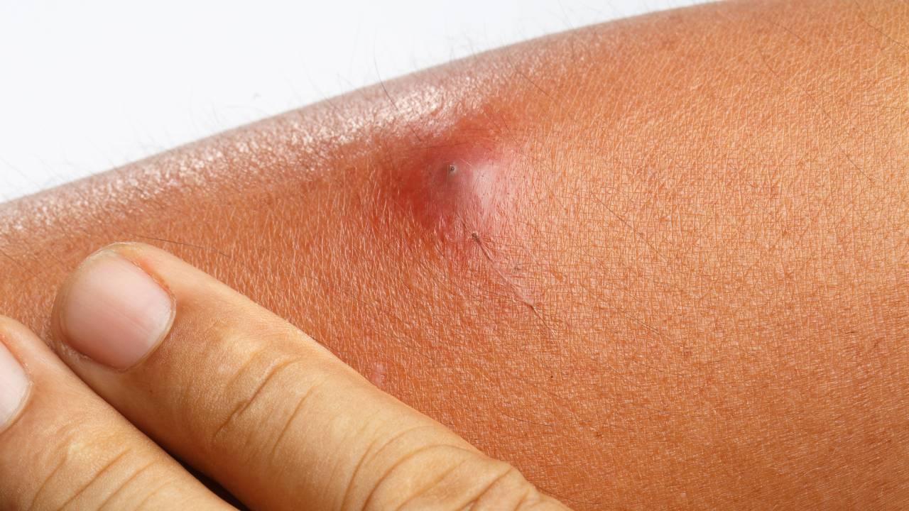 Abscesso: o que é, Sintomas, Causas, Tipos e Tratamento.