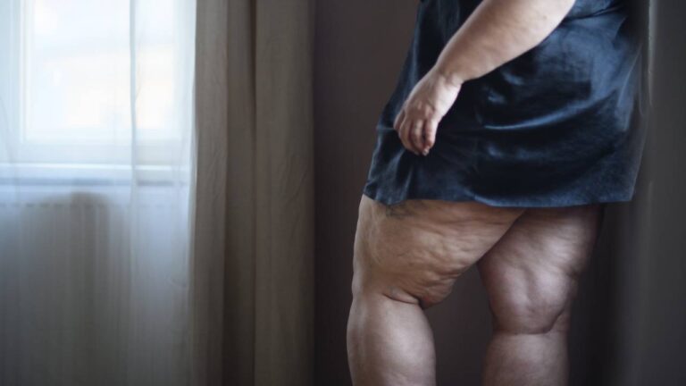 Lipedema: O que é, Sintomas, Causas, Diagnóstico e Tratamento.